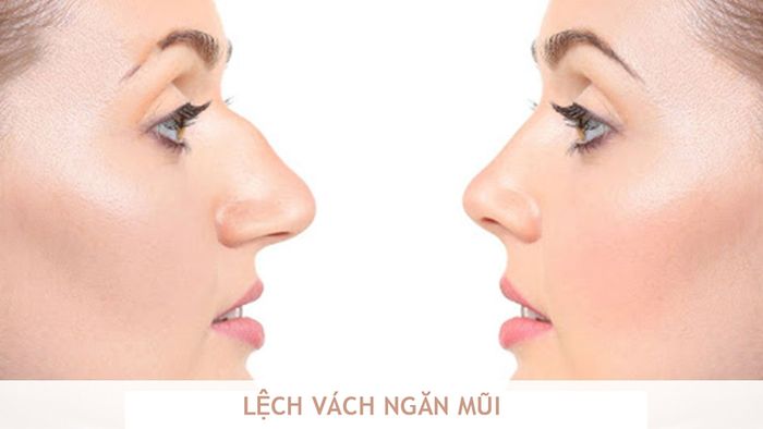 Lệch vách ngăn mũi là một nguyên nhân phổ biến gây viêm xoang mạn tính