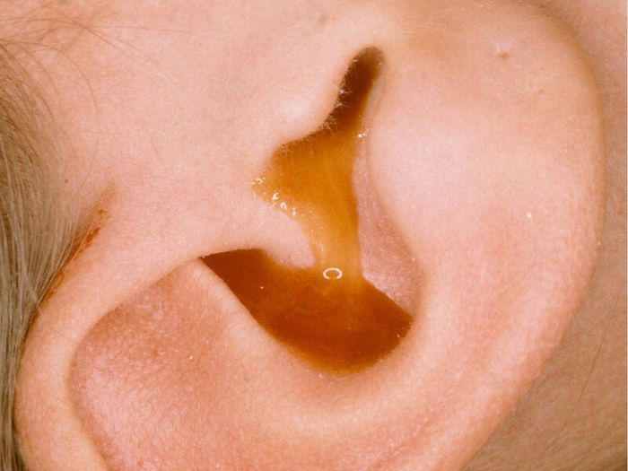 Tai chảy mủ là triệu chứng của nhiều vấn đề tai, phổ biến nhất là viêm tai giữa