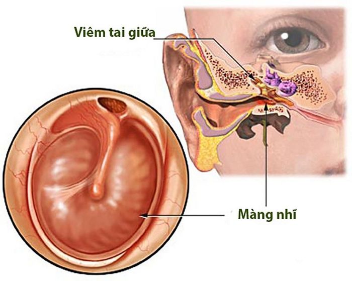 Nếu không xử lý đúng cách khi trẻ mắc viêm tai giữa nung mủ, có thể gây ra thủng màng nhĩ