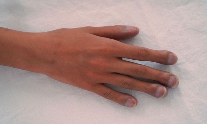 5 giây để đánh giá nguy cơ ung thư phổi