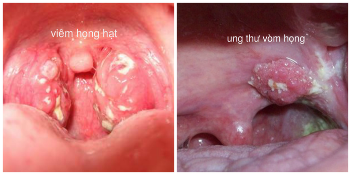 Nội soi vòm họng giúp phát hiện các bất thường bên trong cổ họng, mũi và thanh quản.