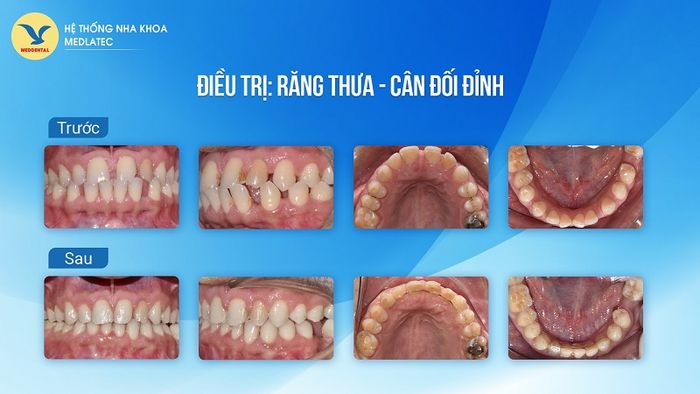 Hình ảnh trước và sau khi niềng răng của các khách hàng được thực hiện tại MedDental