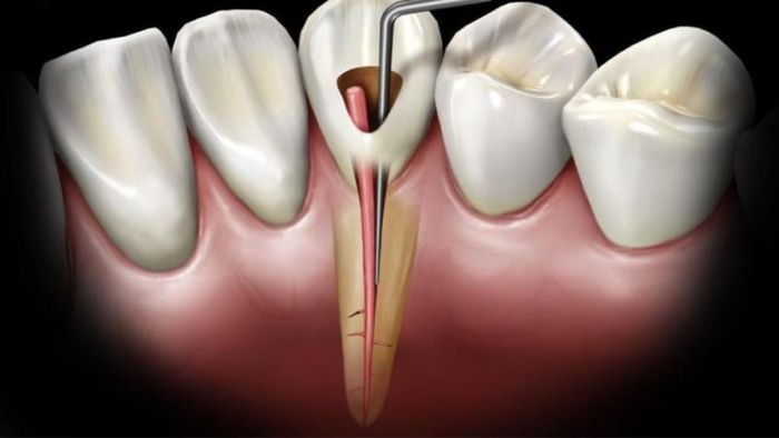 Hầu hết các trường hợp, bác sĩ sẽ tiến hành lấy toàn bộ tủy răng trong một lần.