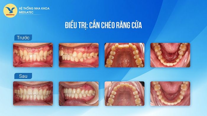 Răng sẽ trở nên đều và thẳng hàng trên cung hàm sau quá trình niềng