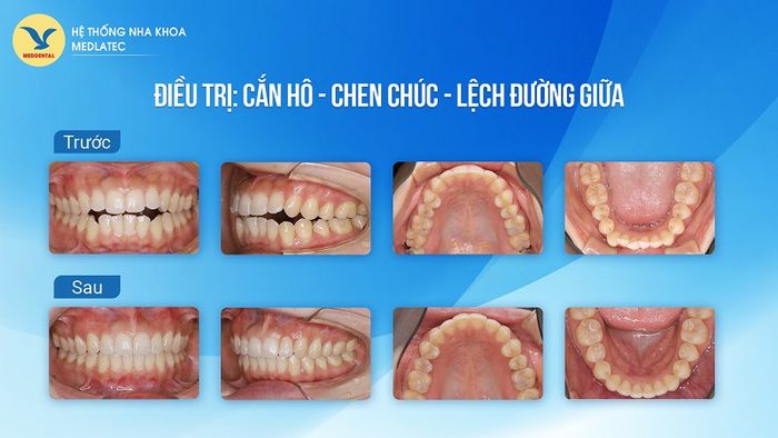 Hình ảnh sau khi niềng răng thành công, mang lại hàm răng đều đẹp