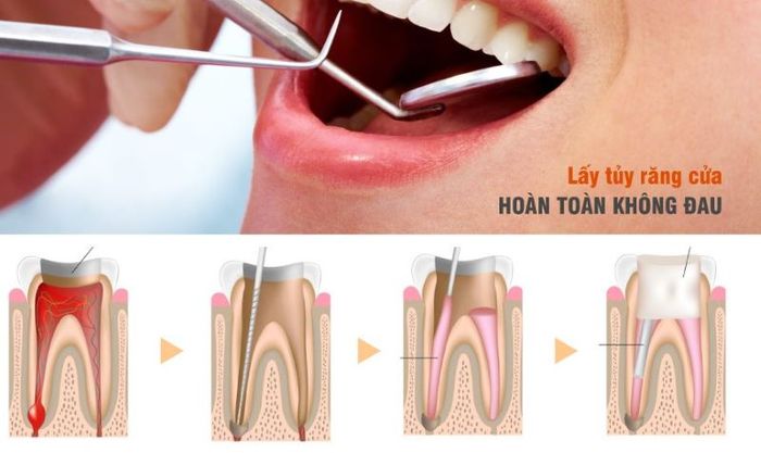 Lấy tủy răng cần được thực hiện sớm để tránh các biến chứng