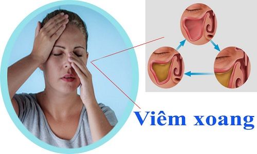 Bệnh viêm xoang