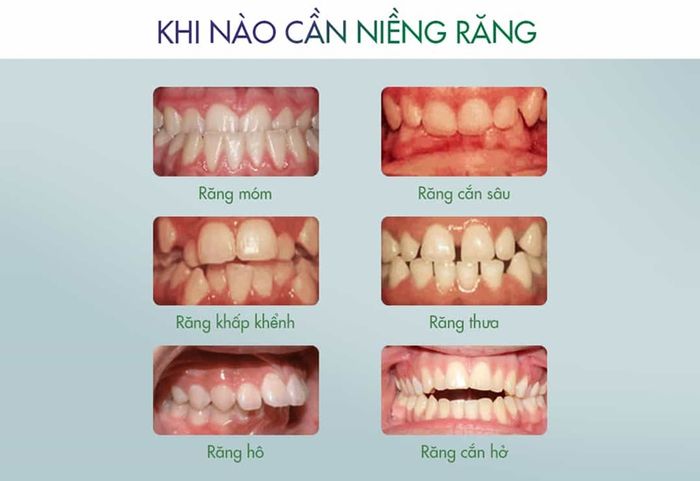 Nếu bạn gặp vấn đề về răng hô và không đều thì nên niềng răng ngay từ sớm