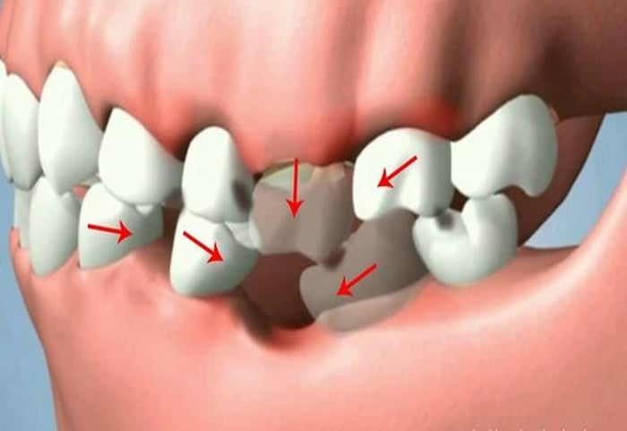 Mất răng có thể tạo ra nhiều vấn đề nghiêm trọng