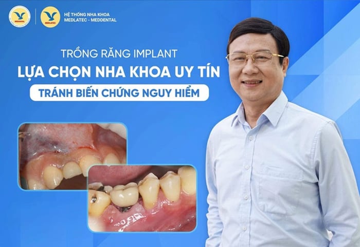 Quý bệnh nhân hoàn toàn có thể tin tưởng khi trồng răng tại MedDental