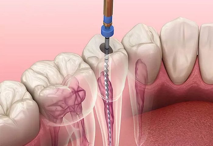 Bệnh nhân có thể phải lấy tủy răng nhiều lần