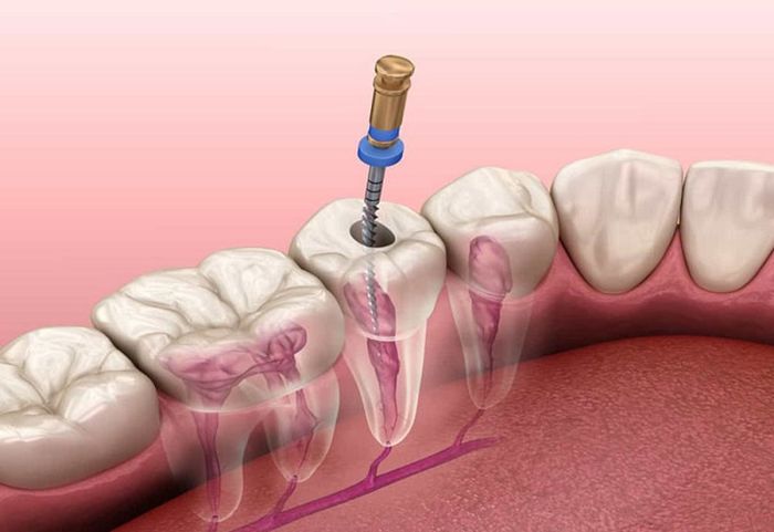 Nhiều người bệnh lo lắng về tuổi thọ của răng sau khi lấy tủy