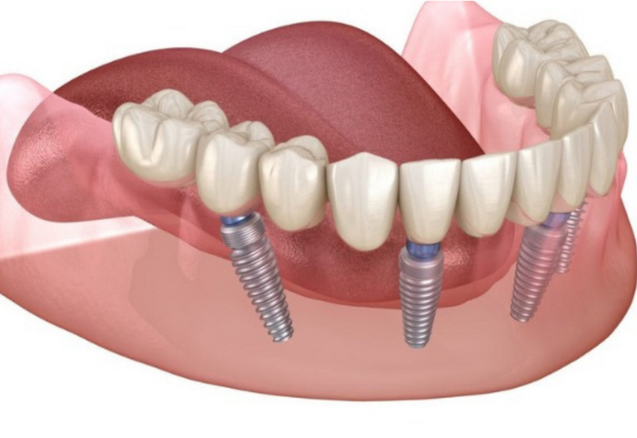 Cấy ghép implant là phương pháp hiện đại và tối ưu để phục hình răng.