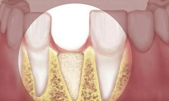 Răng cửa mất có thể làm suy giảm xương ổ răng trong thời gian dài.