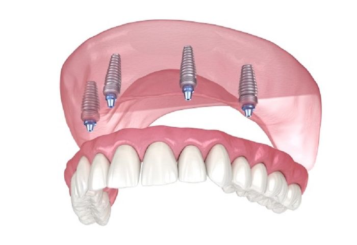 Khắc phục mất răng toàn hàm bằng phương pháp phục hình All on 4 hoặc All on 6