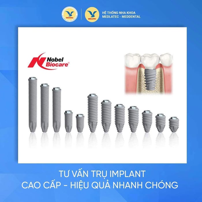 MEDDENTAL đã có nhiều kinh nghiệm trong việc trồng răng cửa Implant