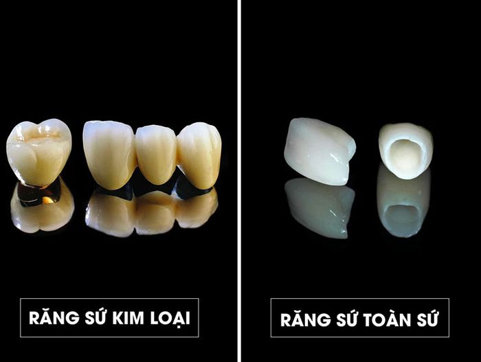 Răng sứ kim loại có lợi thế về mặt chi phí