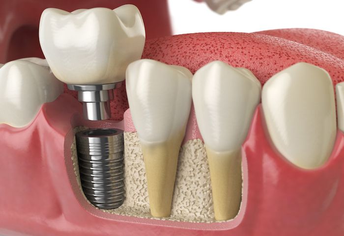 Phương pháp cấy ghép implant mang lại nhiều lợi ích