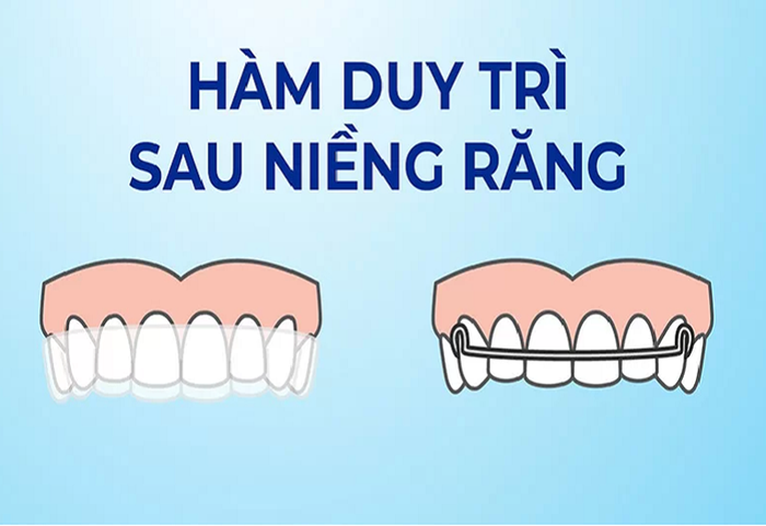 Sau khi niềng răng, cần sử dụng hàm giữ để duy trì kết quả