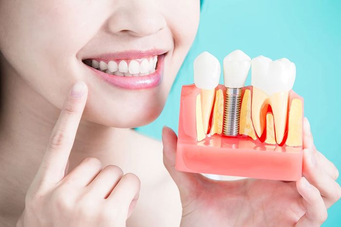 Ưu điểm của phương pháp trồng răng khểnh Implant