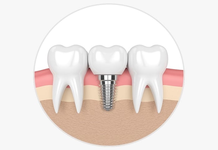 Trồng răng implant là giải pháp tốt nhất để tránh tình trạng hóp má và đảm bảo chức năng nhai của hàm.