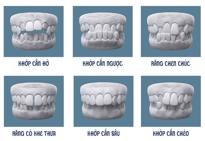 Niềng răng có thể sửa chữa các vấn đề về cấu trúc hàm răng.