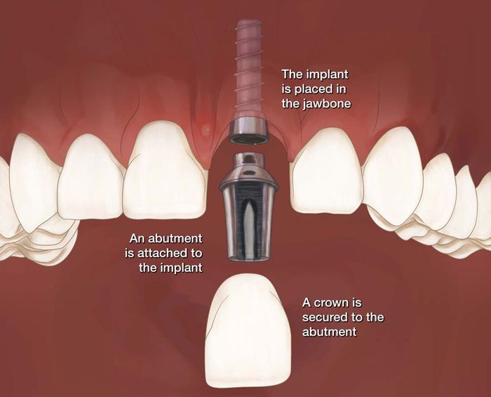 Trồng Implant răng cửa là phương pháp tiên tiến