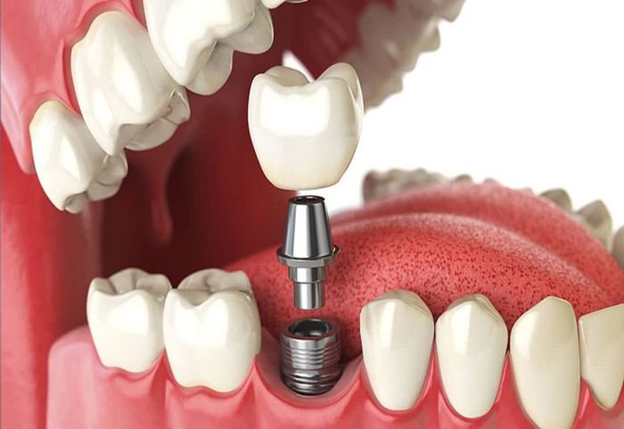 Trồng răng implant mang nhiều ưu điểm.