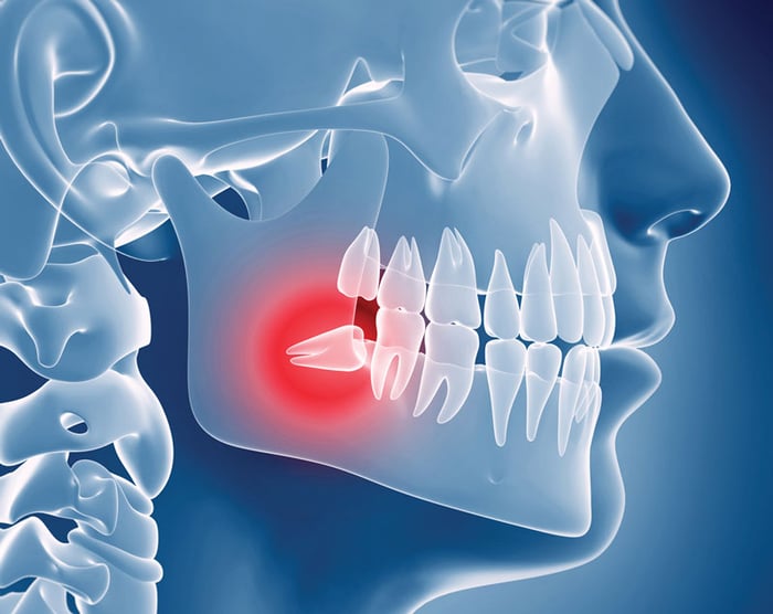 Có nhiều nguyên nhân gây ra việc răng khôn mọc lệch