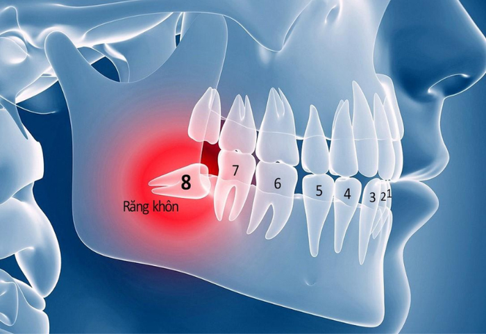 Răng khôn hay răng số 8 là nhóm răng cối lớn chỉ mọc khi xương hàm đã phát triển hoàn toàn