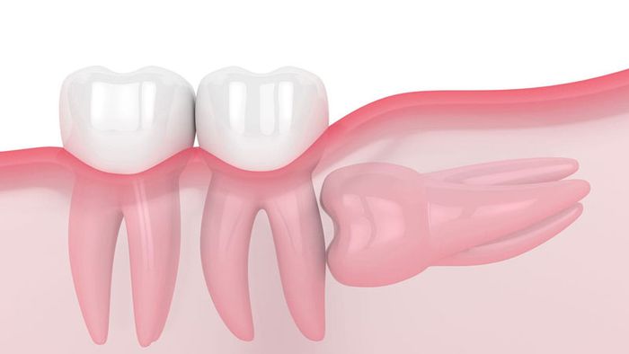 Răng khôn mọc lệch 90 độ thường gây đau đớn cho người bệnh