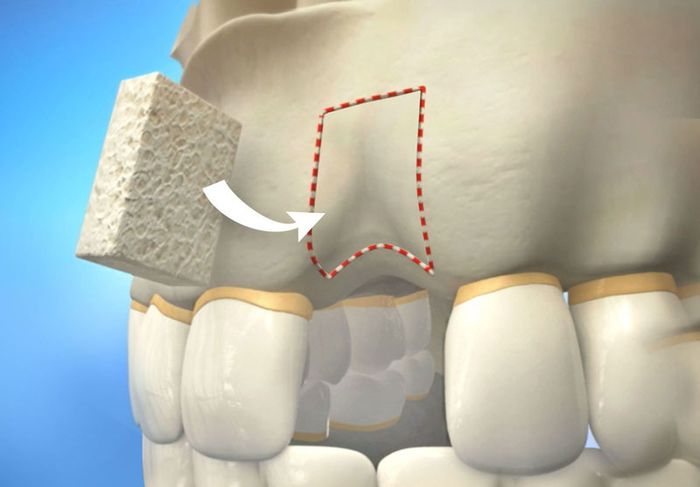 Mô phỏng kỹ thuật ghép xương từ chính - Autograft