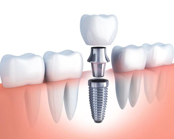 Chi phí cấy ghép răng cố định Implant tương đối cao