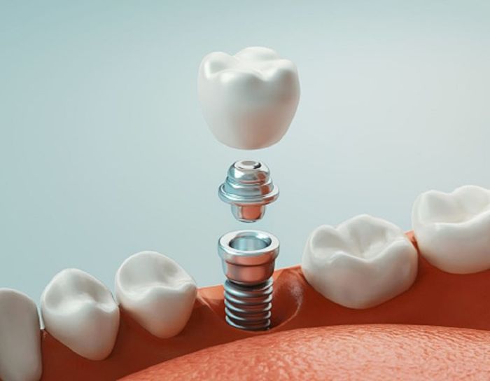 Lựa chọn cấy răng Implant thay thế