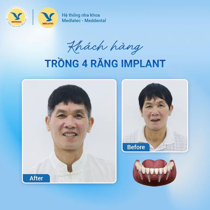 Khách hàng thường rất hài lòng với dịch vụ cấy ghép răng Implant tại MEDDENTAL