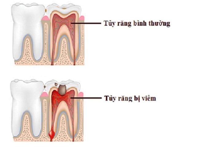 Khi viêm tủy răng đã bắt đầu, việc điều trị càng sớm càng tốt.