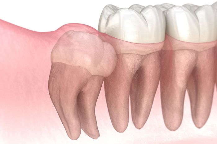 Những người có răng khôn mọc ngầm cần phải được xử lý ngay lập tức.