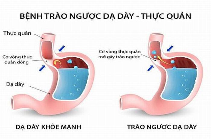 trào ngược dạ dày nên ăn gì