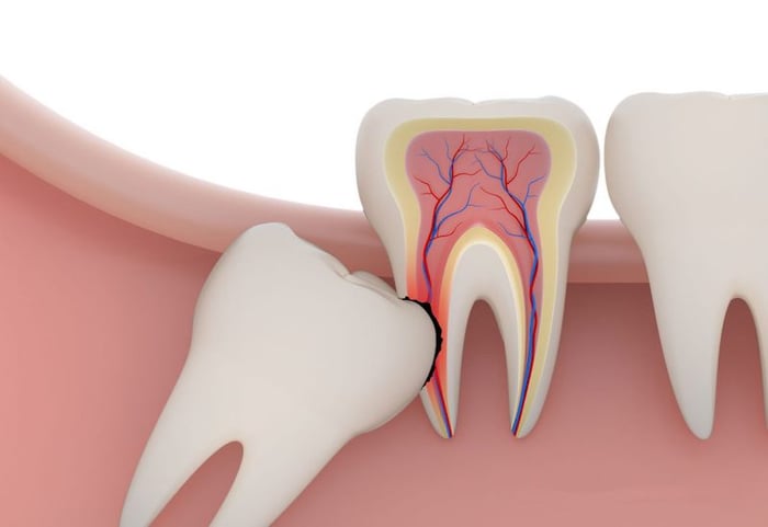 Mặc dù được gọi là răng khôn, nhưng thực tế chúng thường mọc nghiêng