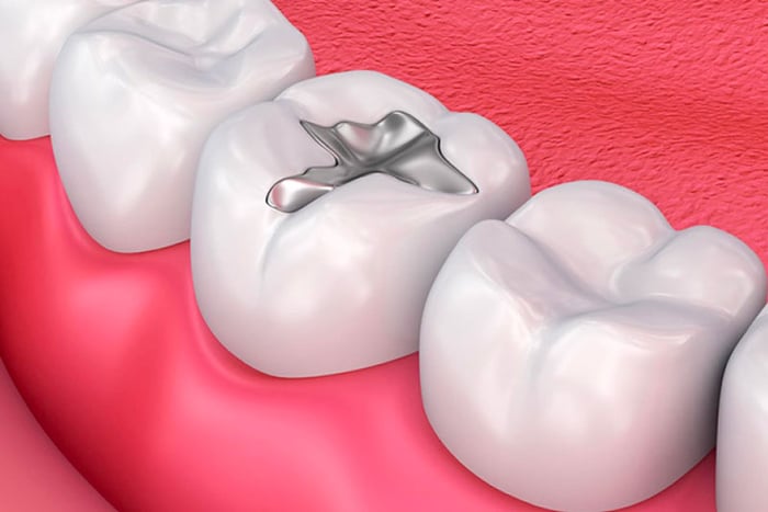 Amalgam được sử dụng phổ biến trong trám răng