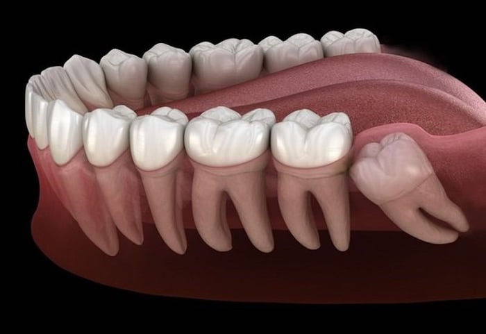 Hình ảnh của một chiếc răng khôn mọc lệch