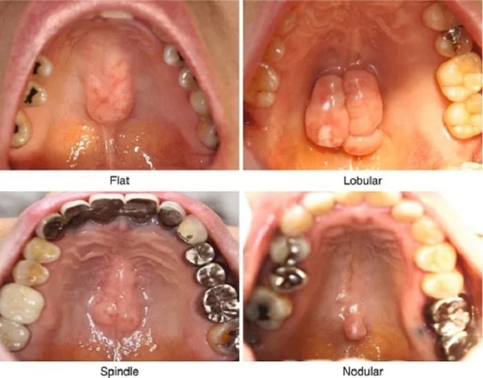 Các loại lồi xương hàm trên dựa vào hình dáng