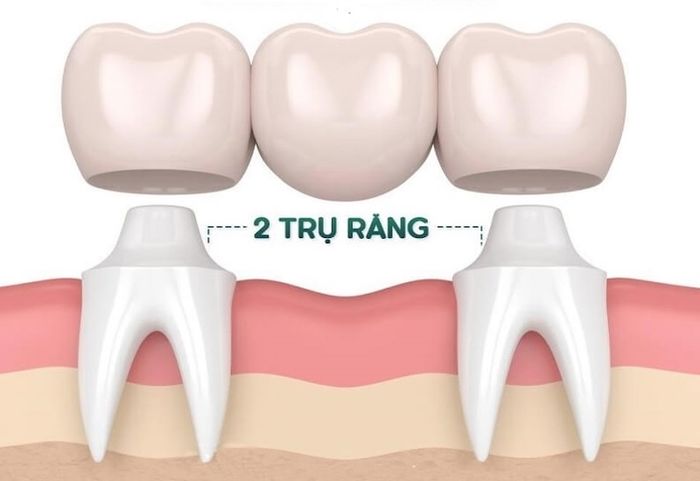 Việc sử dụng cầu răng sứ không thực hiện được trong việc thay thế răng số 7 vì vị trí của nó thường ở cuối hàm.