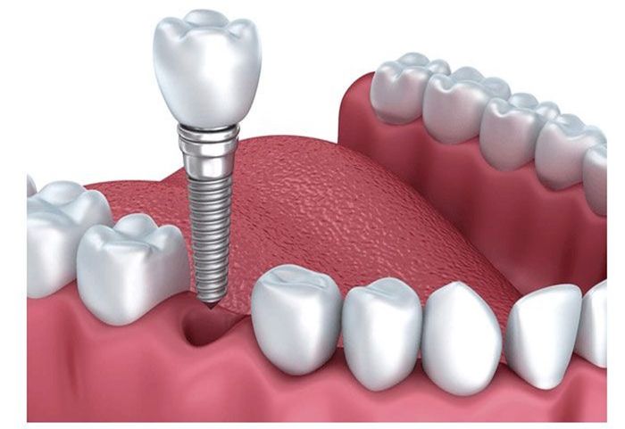 Trồng răng số 6 bằng phương pháp cấy ghép implant