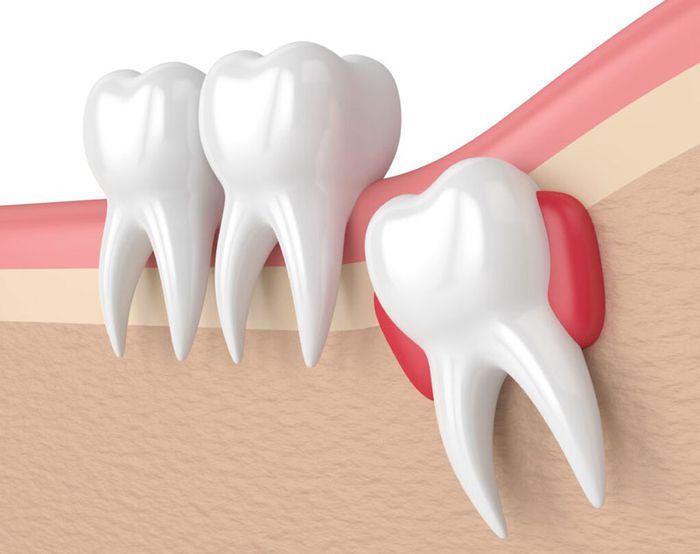 Nên nhổ nếu răng khôn mọc lệch, ảnh hưởng đến cấu trúc hàm răng