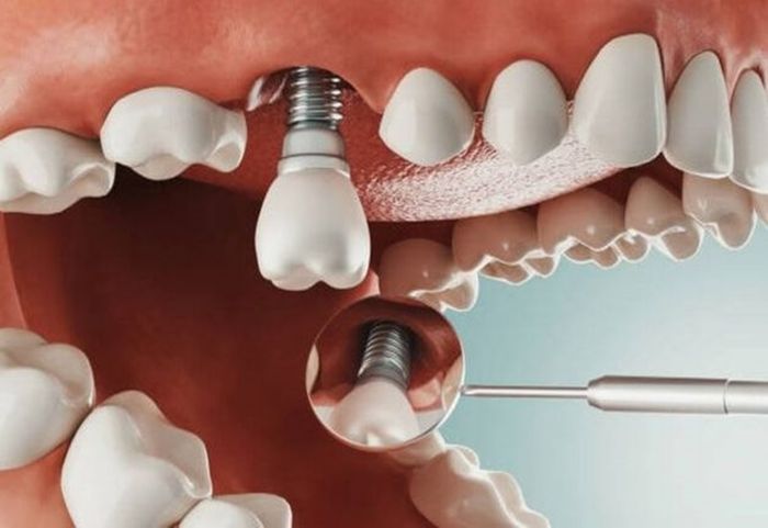 Trồng răng implant là phương pháp phục hình răng tối ưu hiện nay