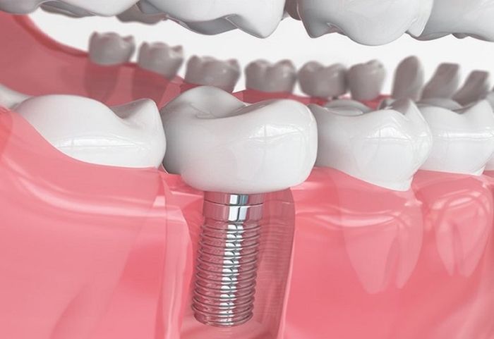 Trồng răng Implant là sự lựa chọn được nhiều người ưa chuộng.