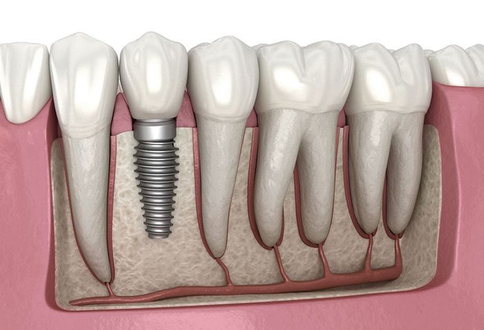 Trồng răng giả là giải pháp tốt nhất để ngăn chặn tiêu xương hàm