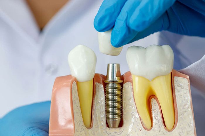 Mô phỏng cấu trúc răng Implant