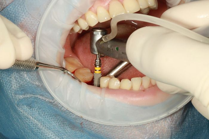 Trồng răng Implant đòi hỏi kỹ thuật phức tạp